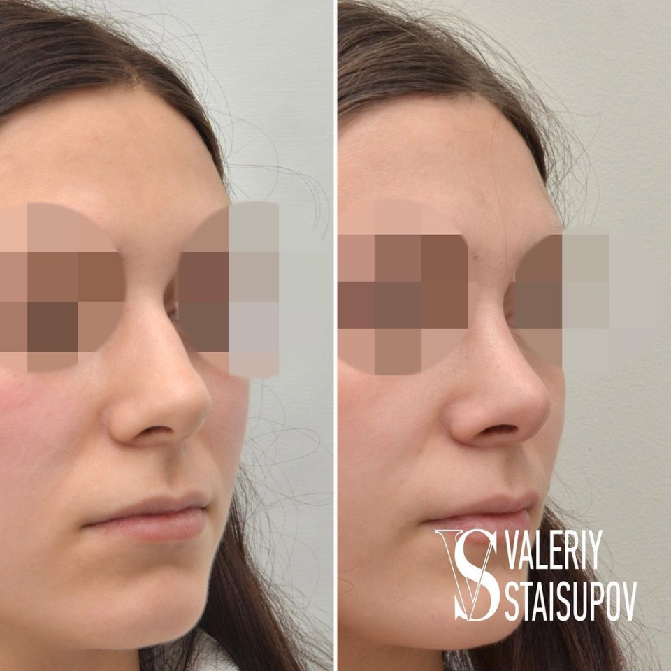 Фото до и после закрытой пластики носа у пластического хирурга Валерия Стайсупова