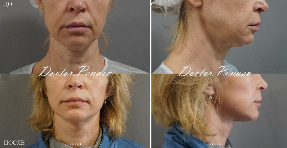 Пациентка доктора Арслана Пенаева до и после омоложения