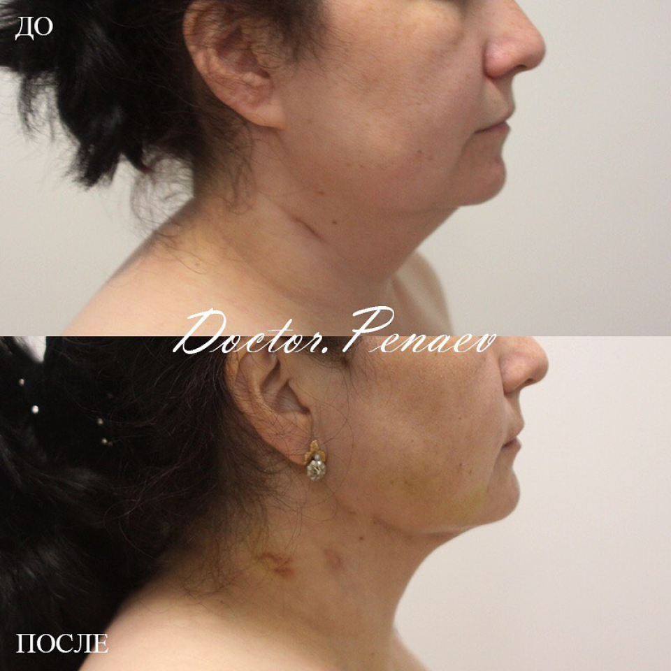 Пациентка доктора Пенаева до и после васер-липомоделирования подбородка