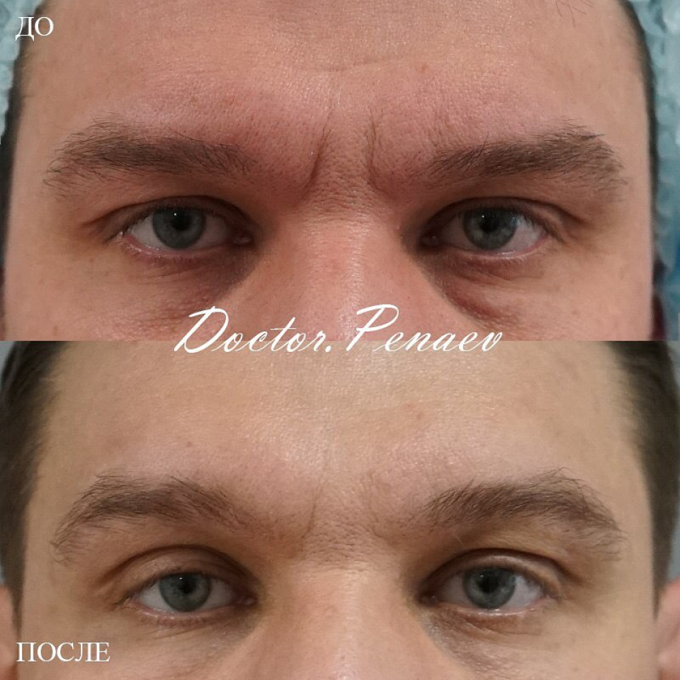 Пациент хирурга Пенаева до и после процедуры Вечный Ботокс