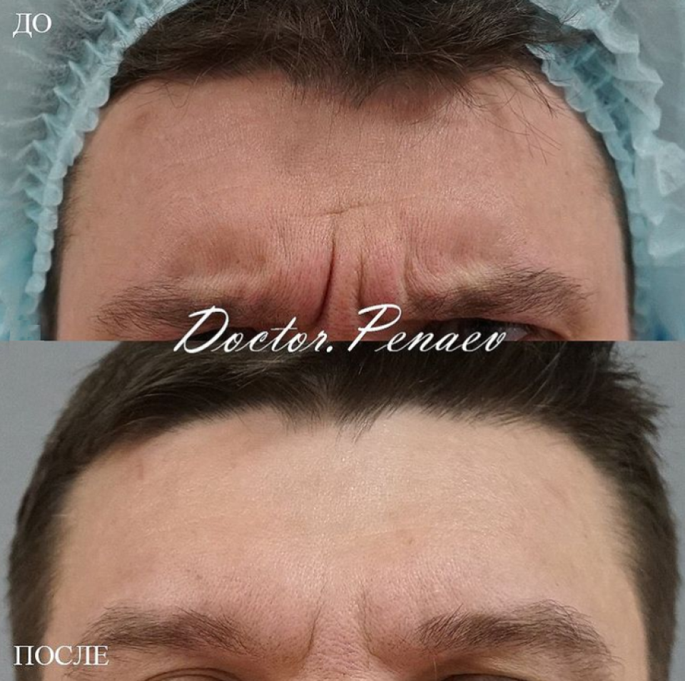 Снимки до и после Вечного ботокса