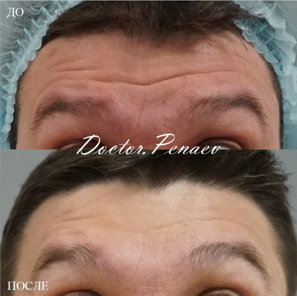 Фото до и после Вечного ботокса