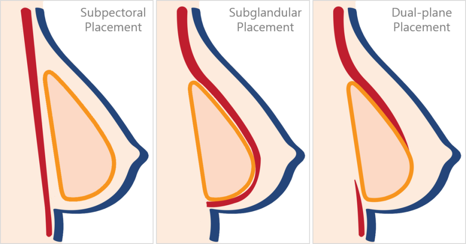 установка имплантов в двух плоскостях