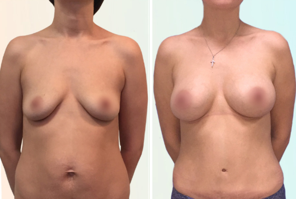 Пластический хирург Дмитрий Рябцев. Послеродовая коррекция груди