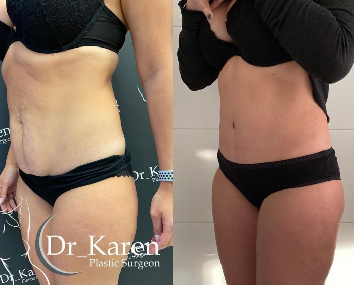 Пациентка пластического хирурга Карена Пайтяна до и после абдоминопластики