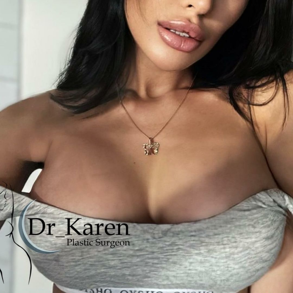Пациентка доктора Карена Пайтяна после маммопластики