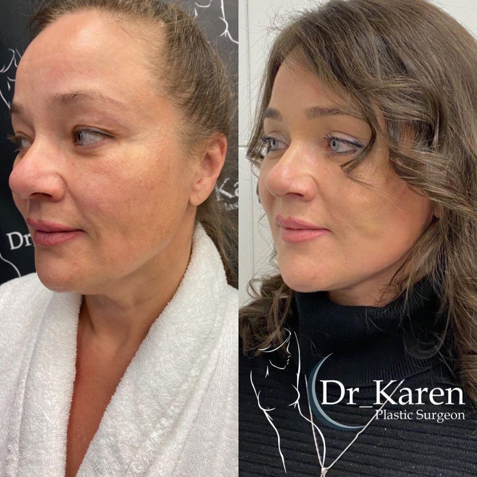 Пациентка пластического хирурга Карена Пайтяна до и после омолаживающей операции
