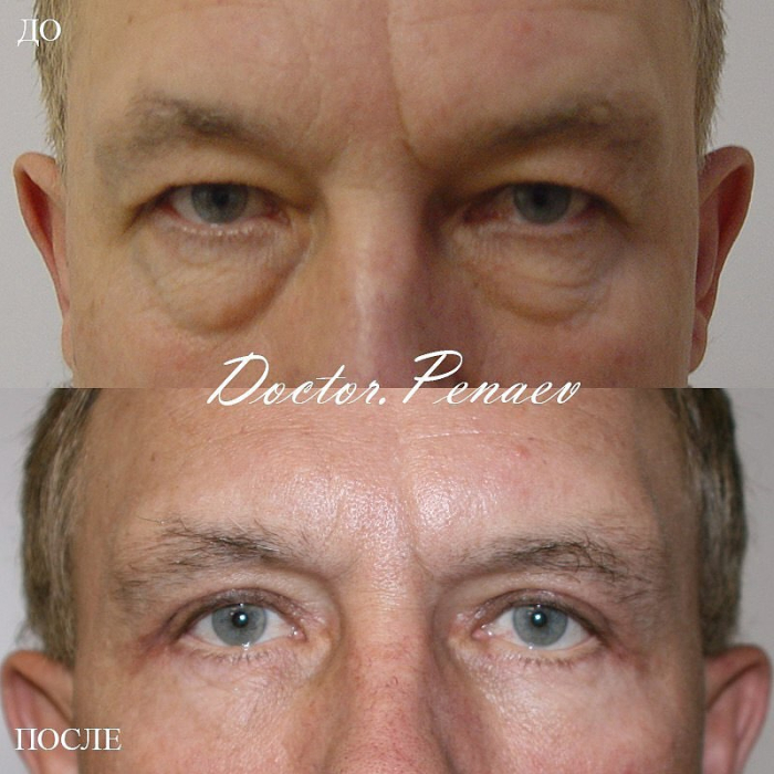 Пациент доктора Пенаева до и после блефаропластики