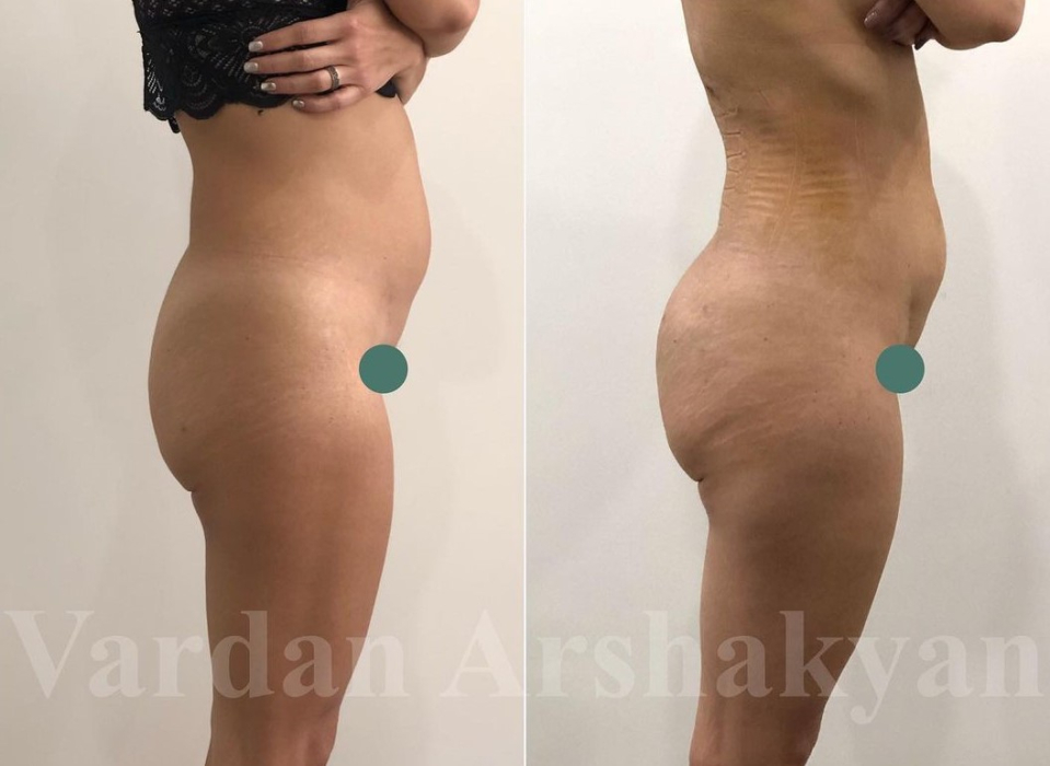 Увеличение ягодиц филлерами