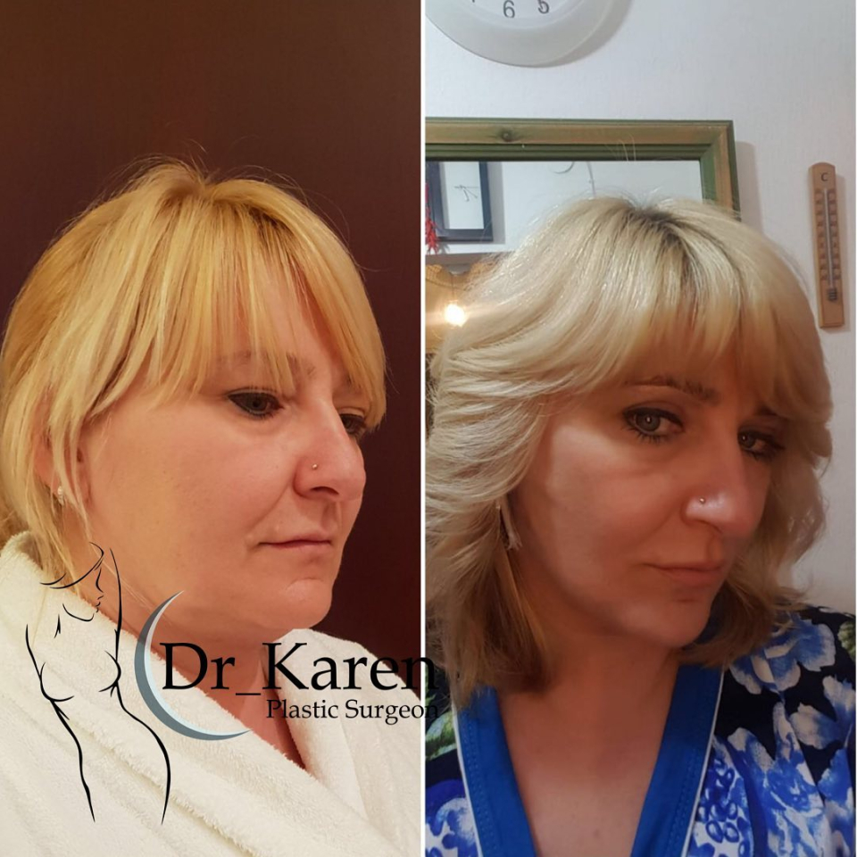 Пациентка пластического хирурга Карена Пайтяна до и после смас-лифтинга лица и блефаропластики
