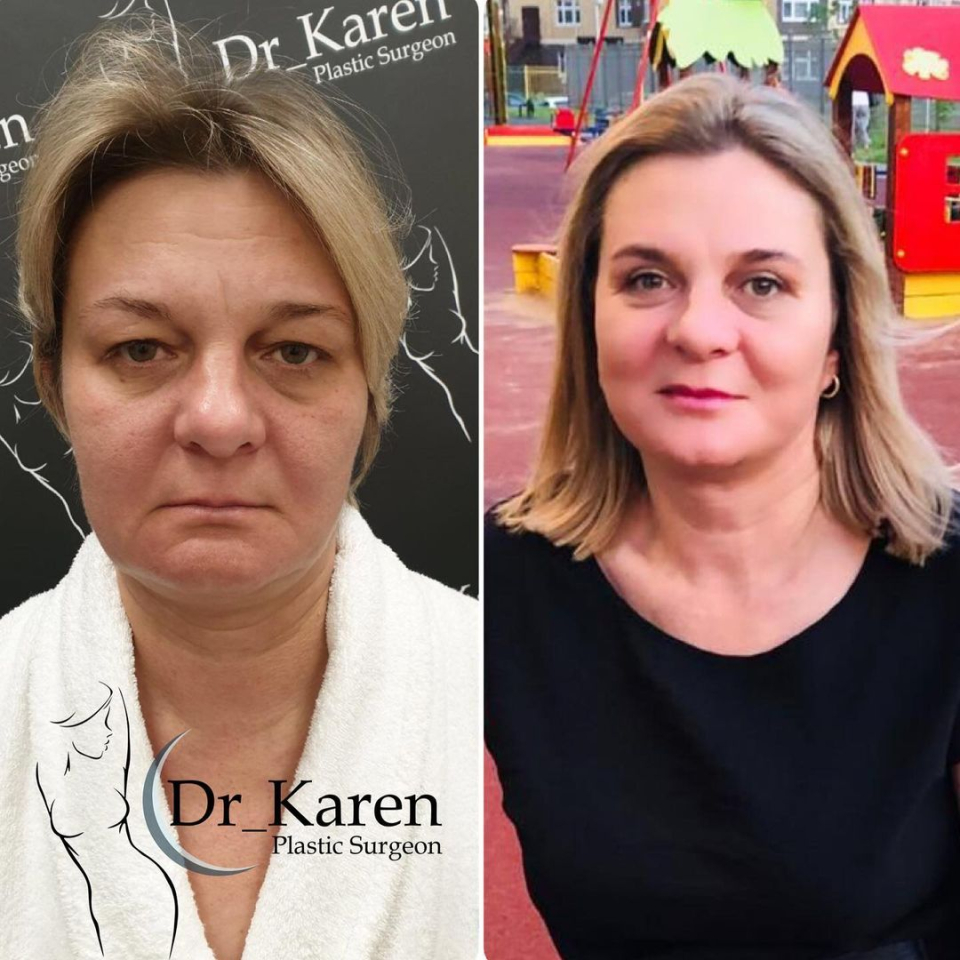 Пациентка пластического хирурга Карена Пайтяна до и после смас-лифтинга лица и блефаропластики