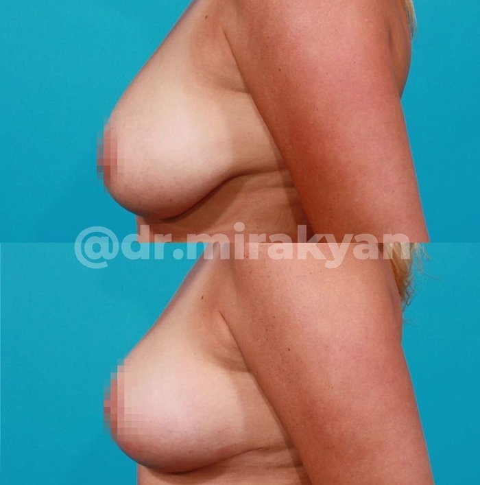 Пациентка до и после подтяжки молочных желез у московского хирурга Гукаса Миракяна