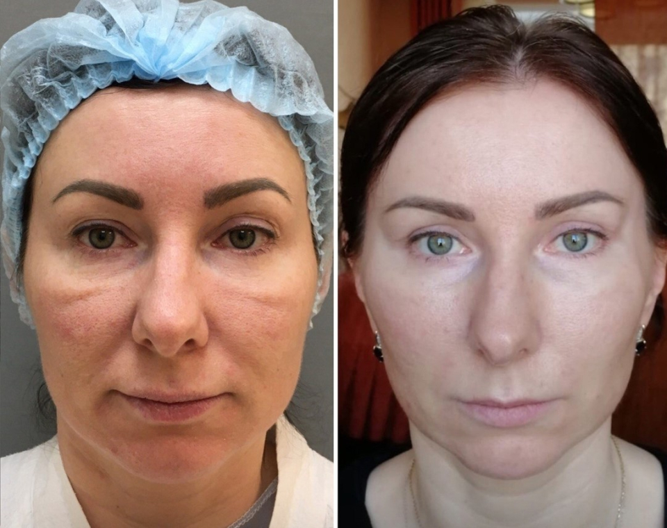 Марина Четверикова подтяжка лица