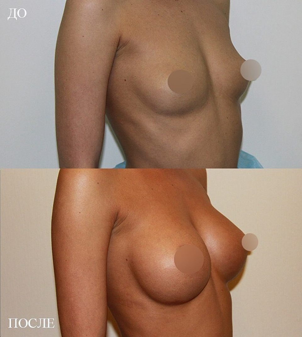 увеличение груди в Москве Пенаев