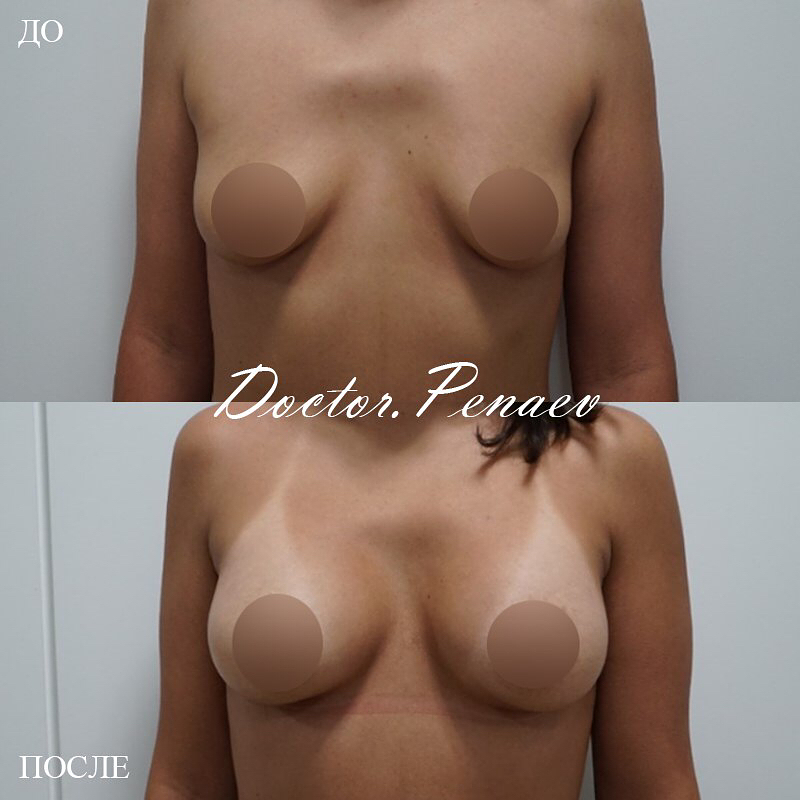 Пациентка доктора Пенаева до и после увеличения груди