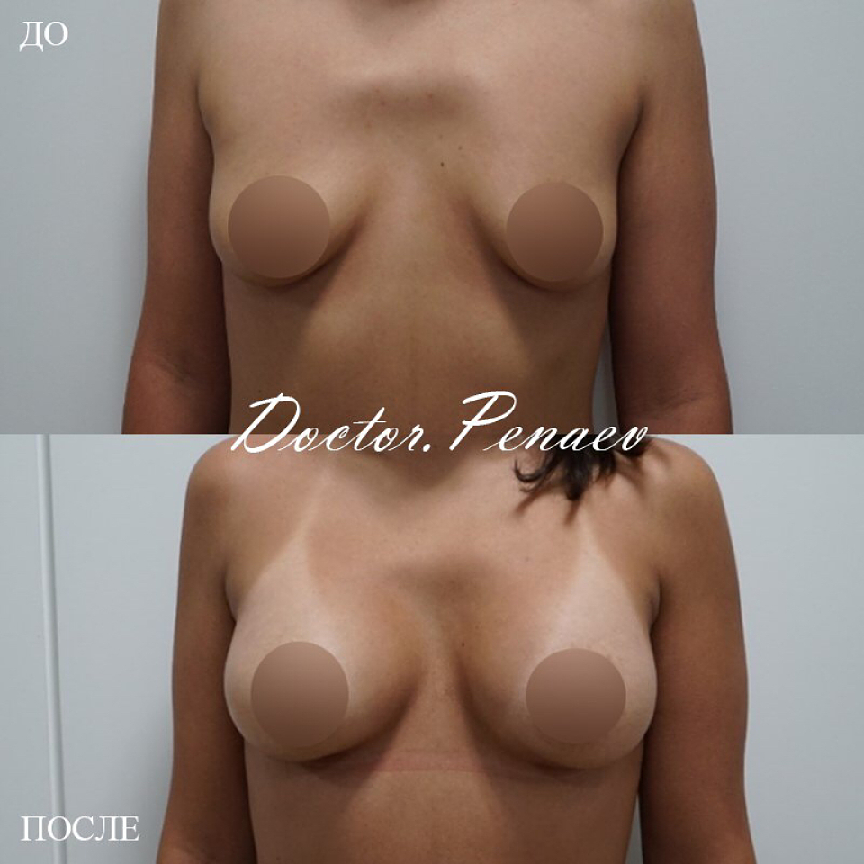 птоз груди увеличение имплантами