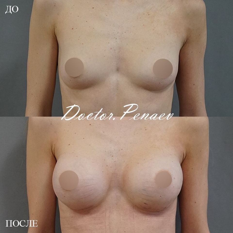 импланты в груди Пенаев