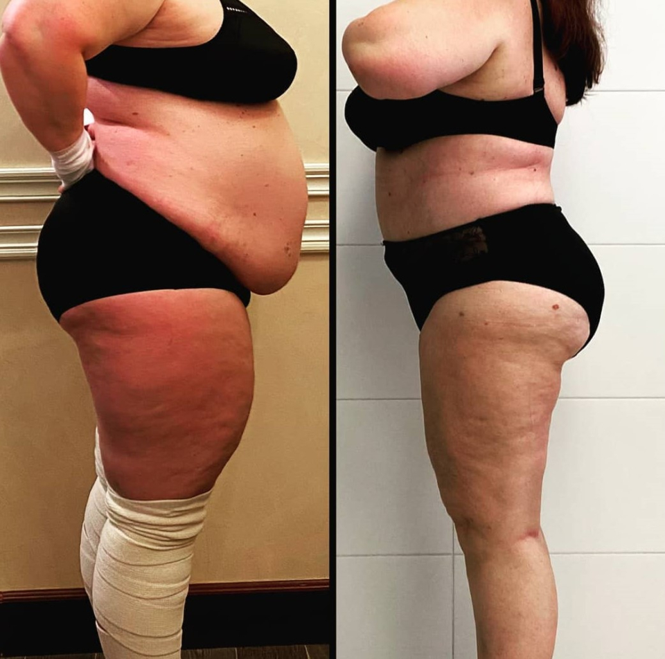 абдоминопластика Дмитрий Рябцев