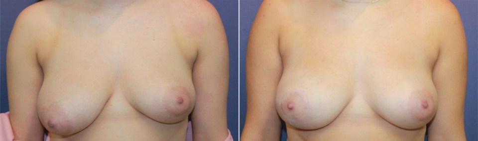 асимметрия груди