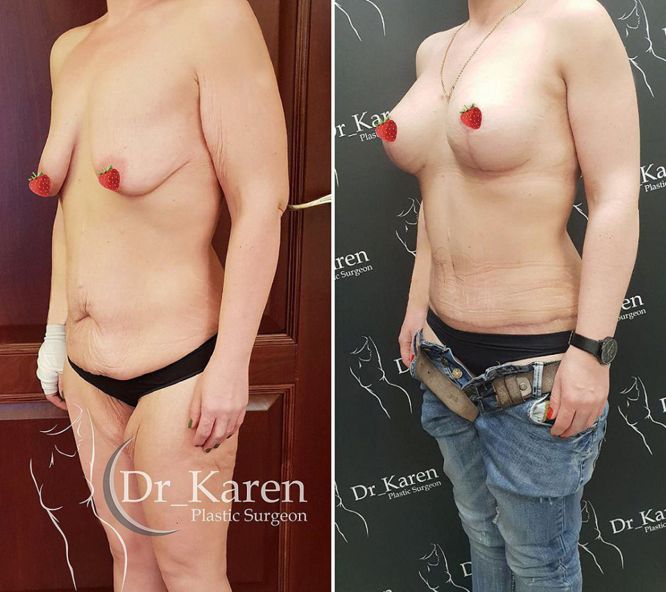 абдомино после родов