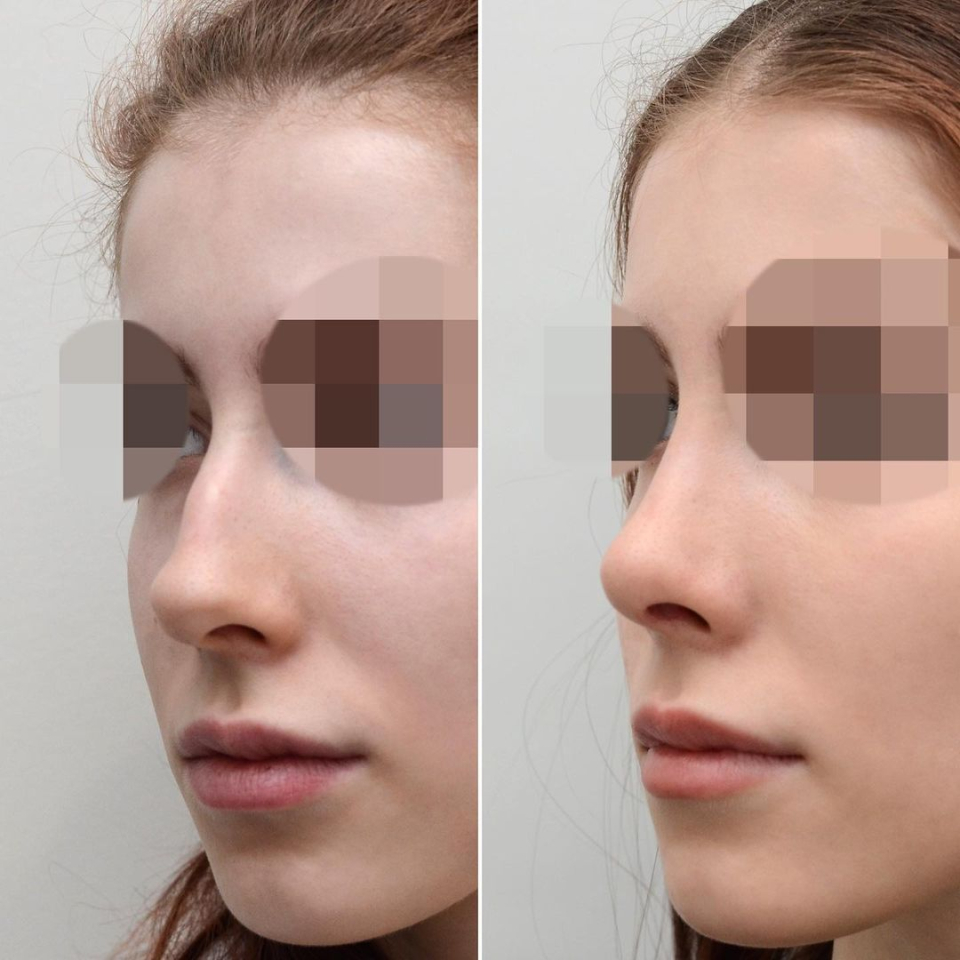 Пациентка доктора Валерия Стайсупова до и после ринопластики
