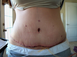 Первые недели после абдоминопластики