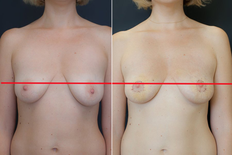 Брест Тайт результат до и после