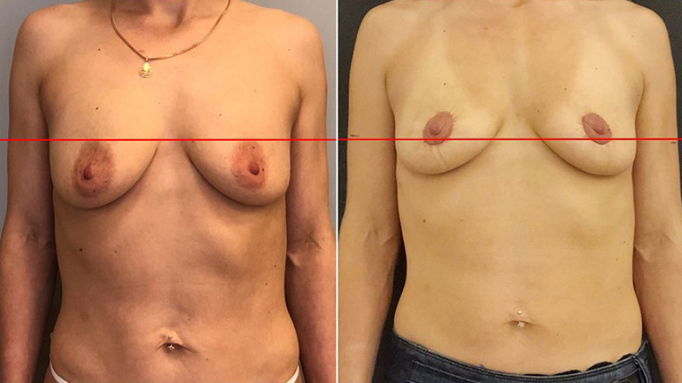 Подтяжка груди Брест Тайт до и после