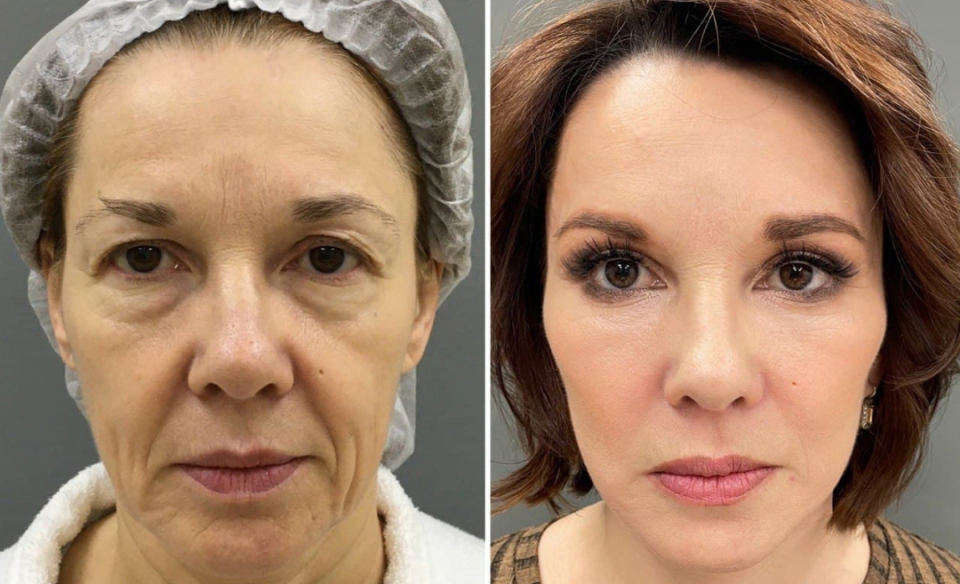 Комплексное омоложение лица Четверикова