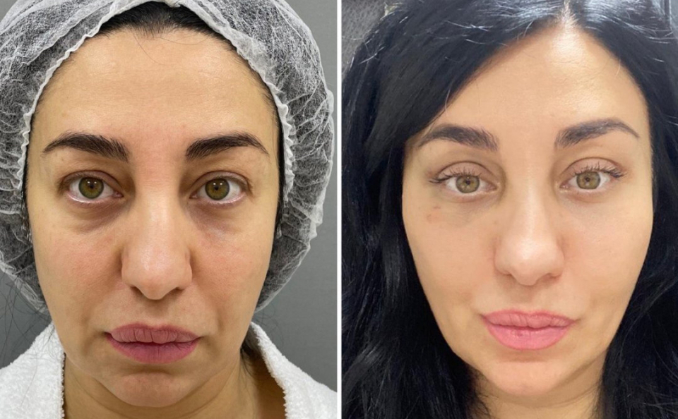 Верхняя блефаропластика