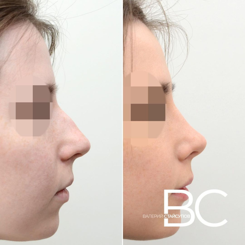 В. Стайсупов. Коррекция носовой перегородки