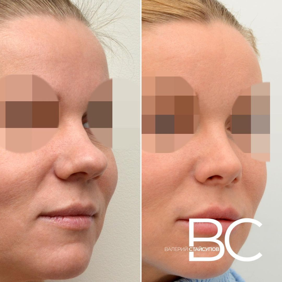 Пациентка доктора Валерия Стайсупова до и после ринопластики