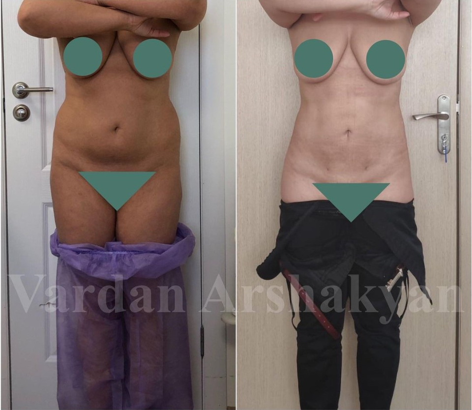 Пациентка доктора Вардана Аршакяна до и после радиочастотного липоскульптурирования тела