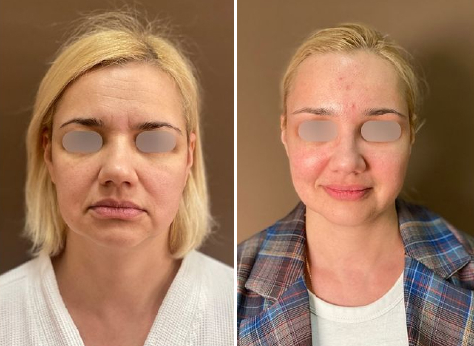 эндоскопическая подтяжка Пшонкина