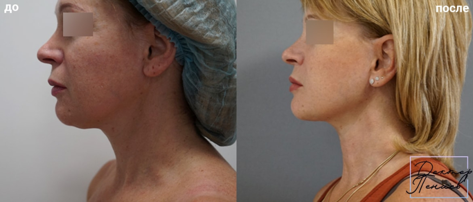 Пациентка пластического хирурга Арслана Пенаева до и после нитевого лифтинга лица