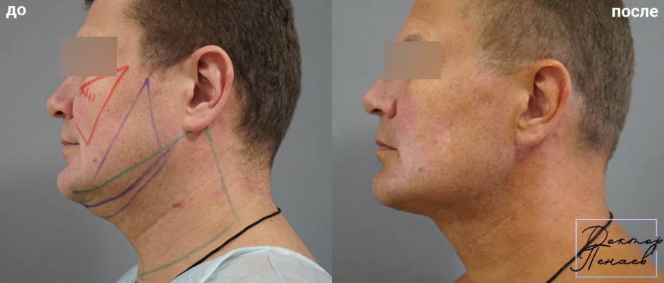 Пациент пластического хирурга Арслана Пенаева до и после омоложения лица.