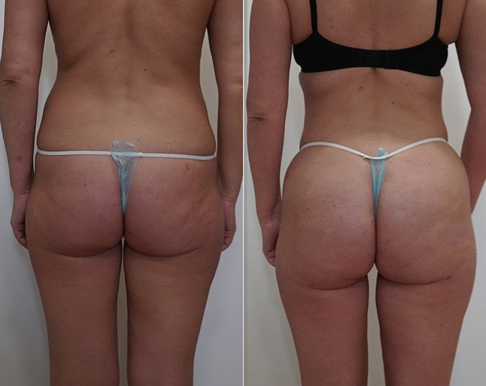 VASER липосакция и липофилинг Арслан Пенаев