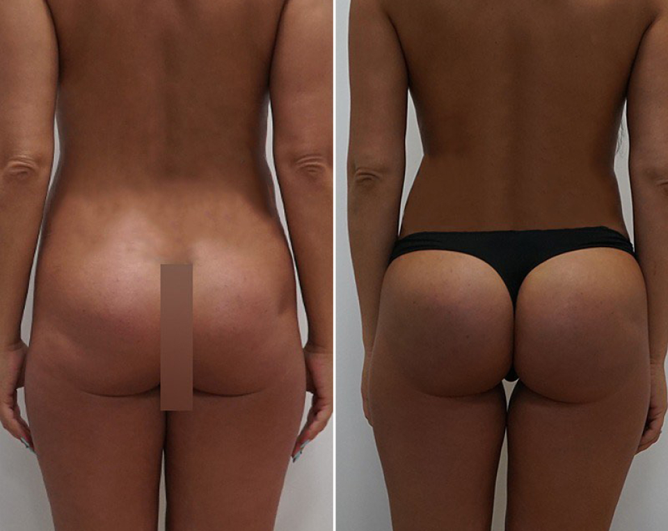 VASER липосакция Арслан Пенаев фото