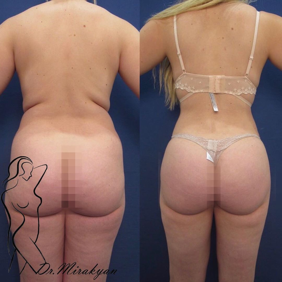 Пациентка доктора Гукаса Миракяна до и после увеличения ягодиц липофилингом