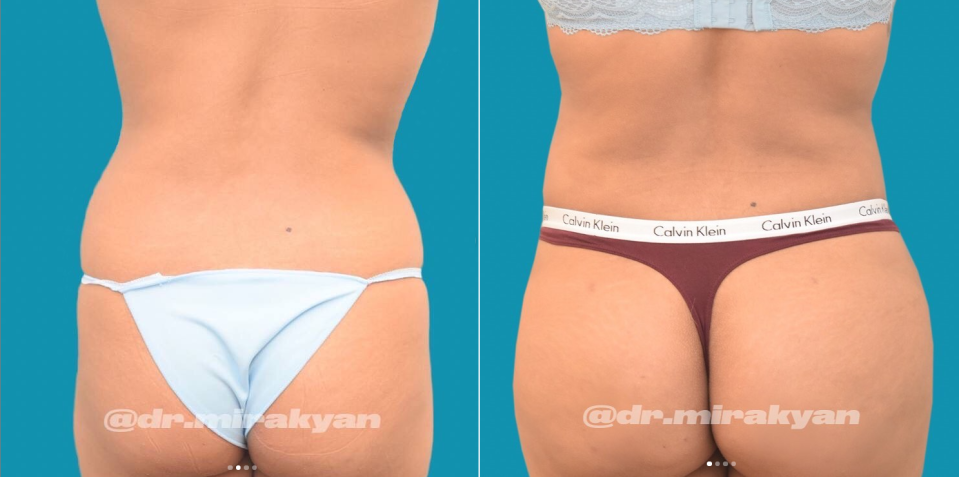 Пациентка доктора Гукаса Миракяна до и после липофилинга ягодиц