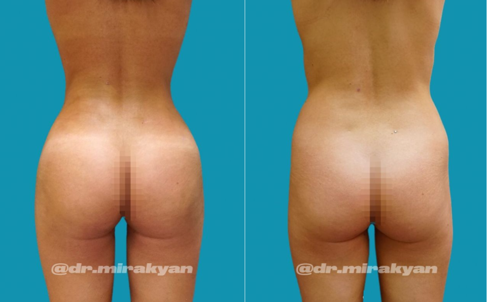 Пациентка доктора Миракяна до и после липофилинга ягодиц