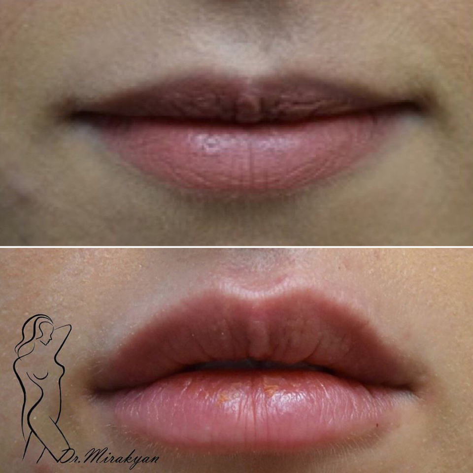 до и после булхорн Москва