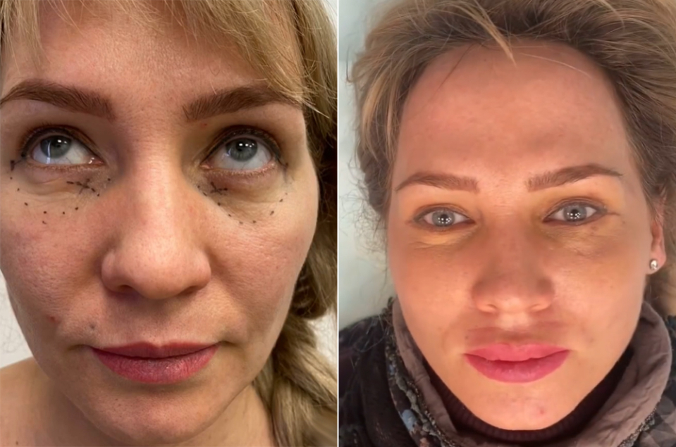 До и после пластики губ