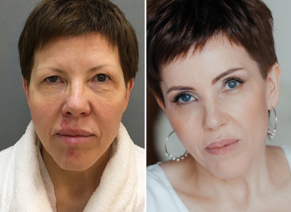 омоложение лица Четверикова