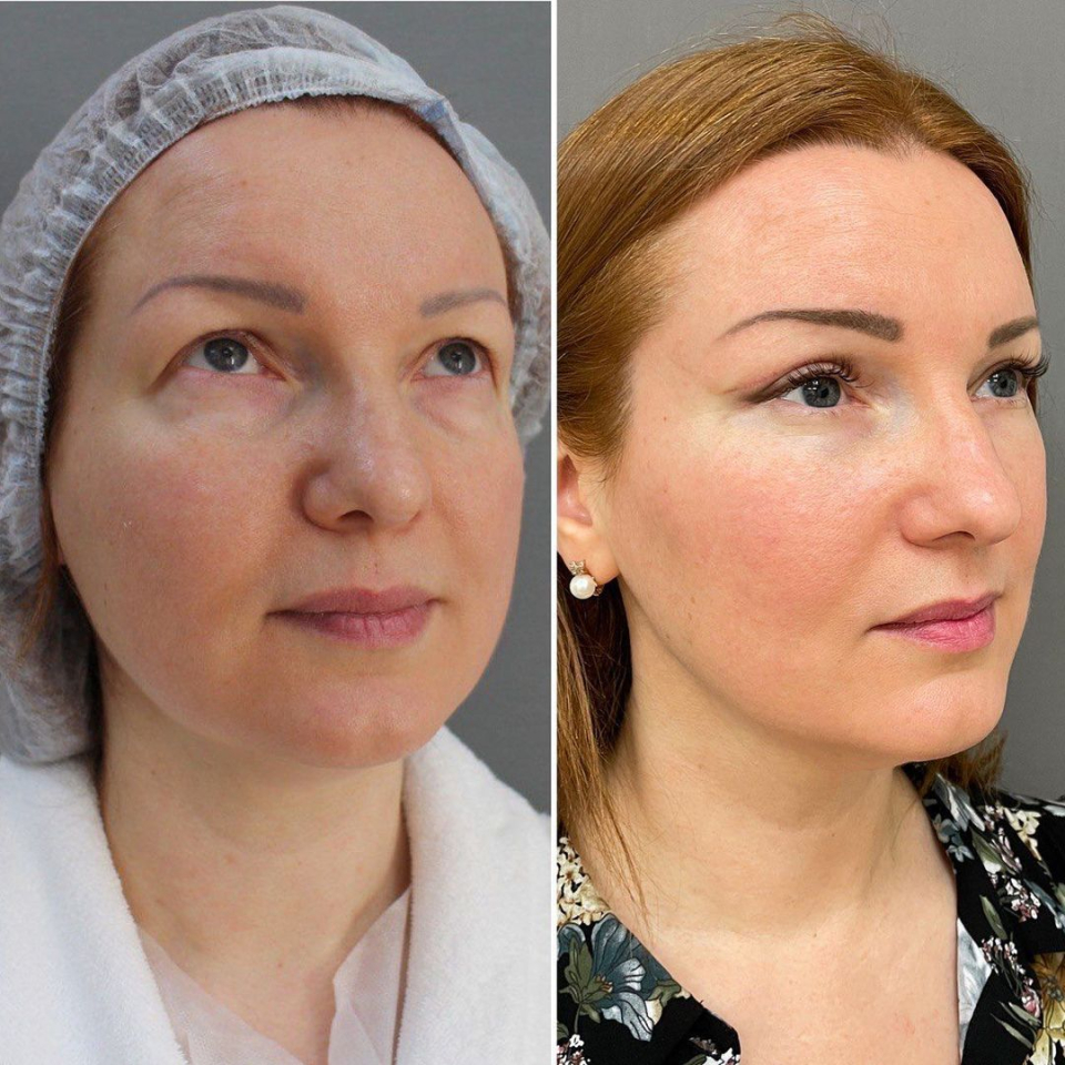 Пациентка пластического хирурга Марины Четвериковой