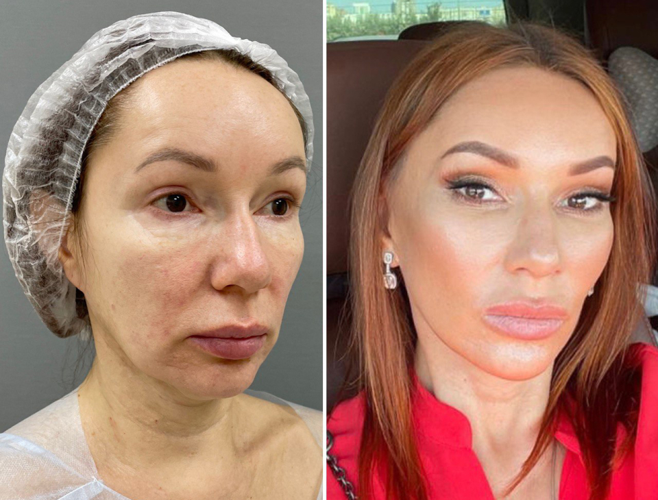 омоложение лица в Санкт-Петербурге