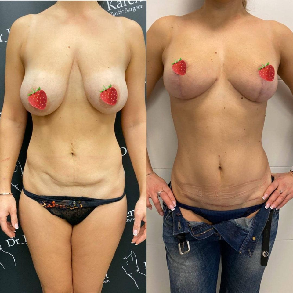 Пациентка до и после подтяжки груди и живота у доктора Карена Пайтяна
