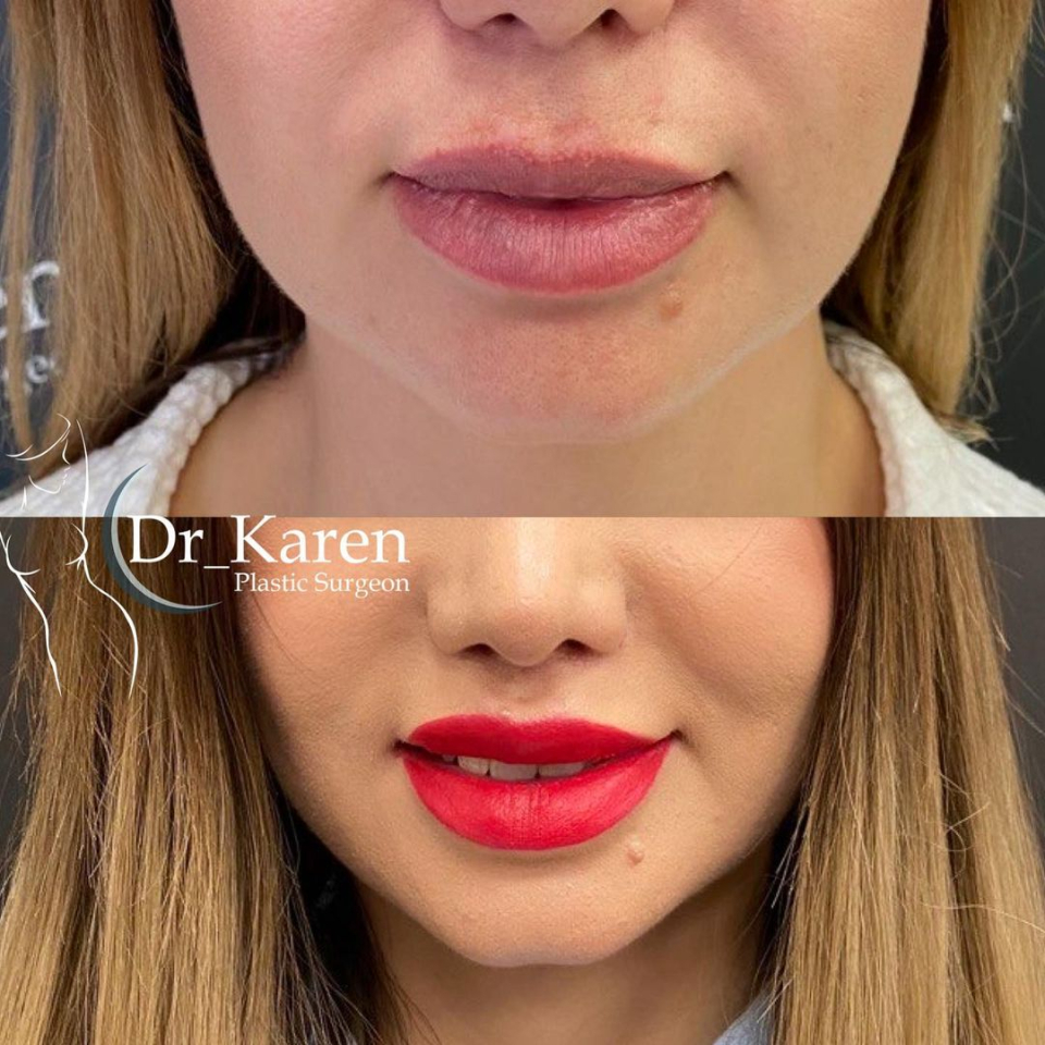 Пациентка доктора Карена Пайтяна до и после операции Булхорн