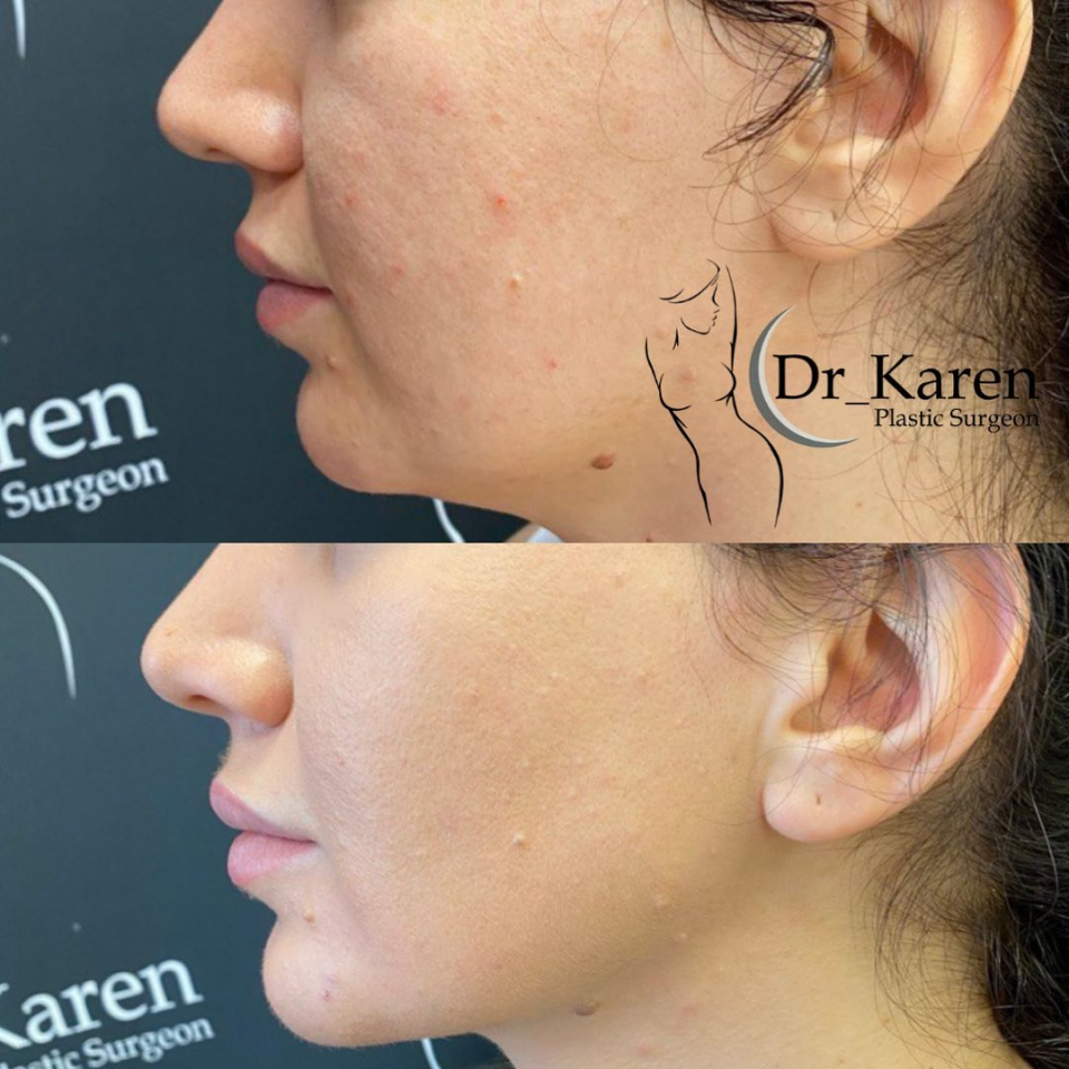 Пациентка доктора Пайтяна до и после удаления комков Биша. Также выполнено липомоделирование подбородка