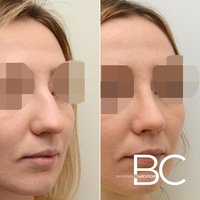 Пациентка хирурга Валерия Стайсупова до и после закрытой ринопластики носа с толстой кожей